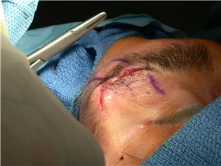 Facial Scar Surgery